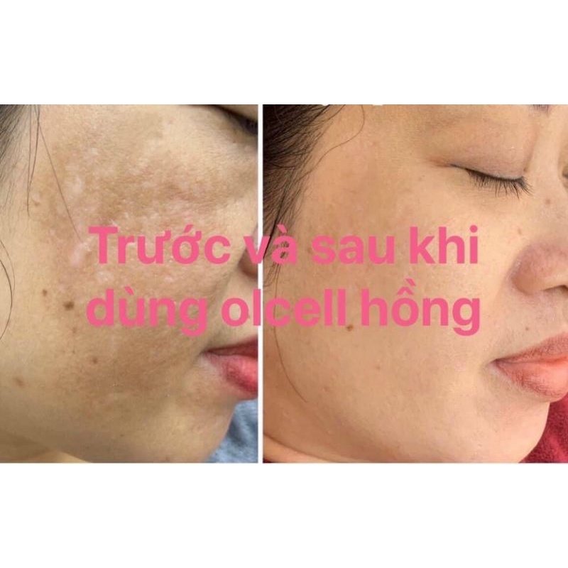 Kem nám, tàn nhàng Ol- cell Hàn Quốc
