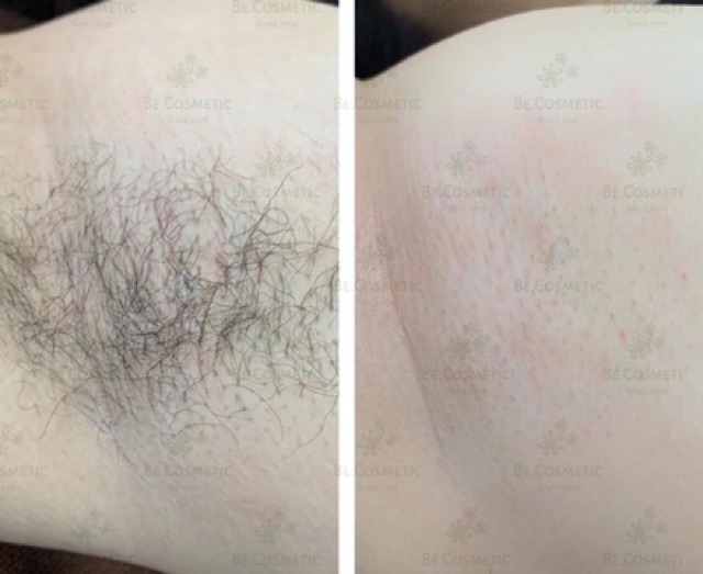 [Mã SKAMLTSM9 giảm 10% đơn 99K] Set tẩy lông BE (kem + serum ) | BigBuy360 - bigbuy360.vn