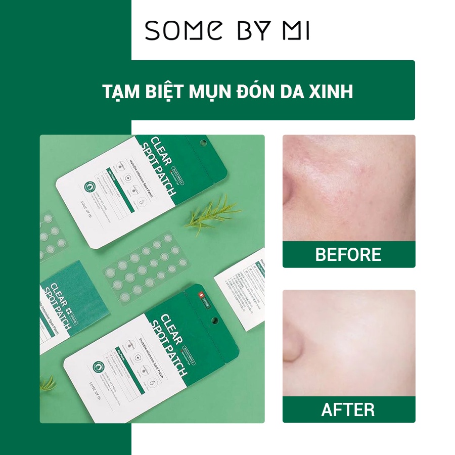 [Mã BMTTC60K giảm đến 60K đơn 50K] Miếng Dán Mụn Some By Mi Don't Pop It. Just Leave It 18Pcs 8g