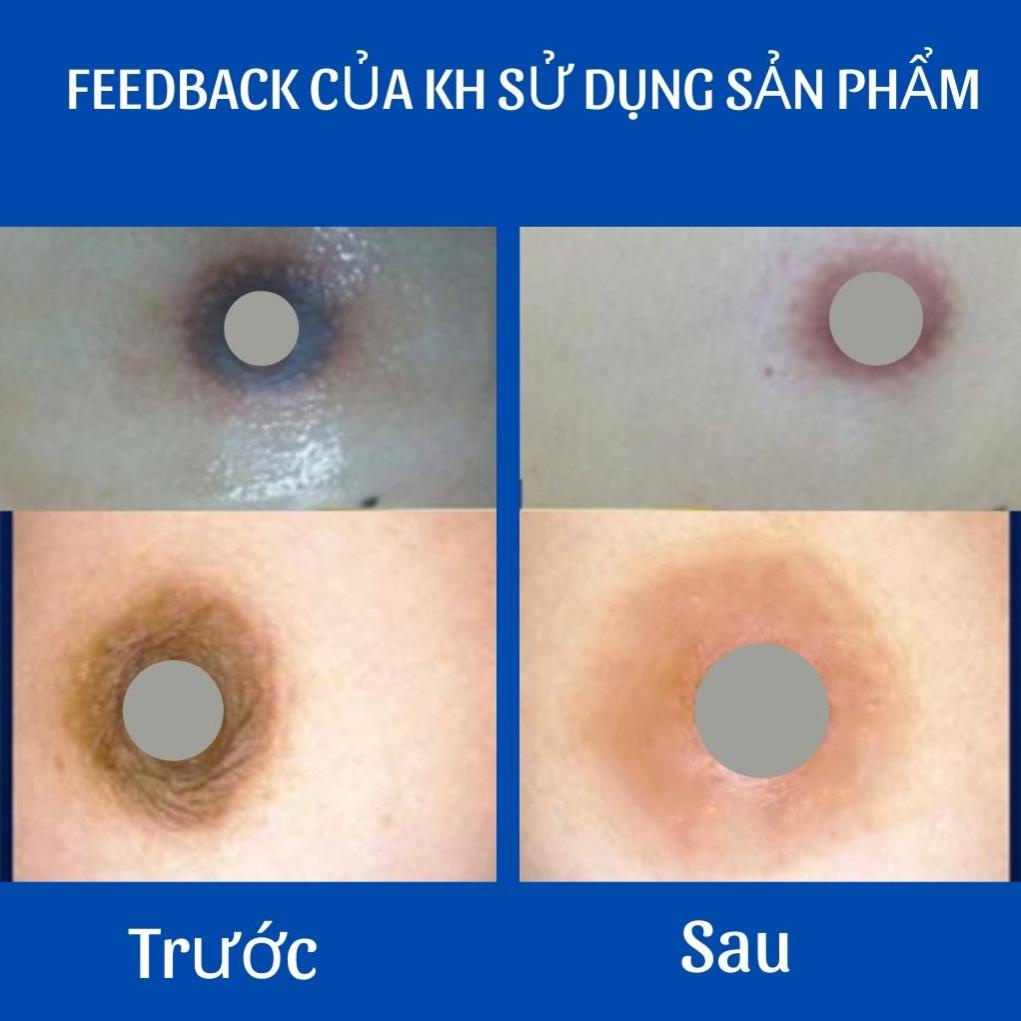 Serum giảm thâm mông chân tay nách bẹn Peel Pink 10ml .
