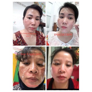 SÉT TCA CHẤM PEEL NÁM TÀN NHANG 35%