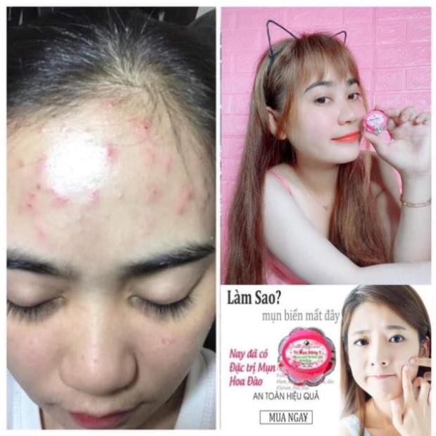 Kem Mụn Đông Y Hoa Anh Đào