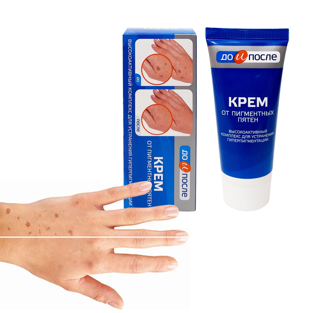 Kem Nám Tay Kpem Nga 45ml Kem Giảm Đốm Nâu Tay Đồi Mồi