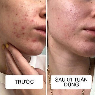 Kem Hỗ Trợ Mụn Nga SOS Propeller Giảm Viêm 24h Propeller 50ml Key4 Lab | BigBuy360 - bigbuy360.vn