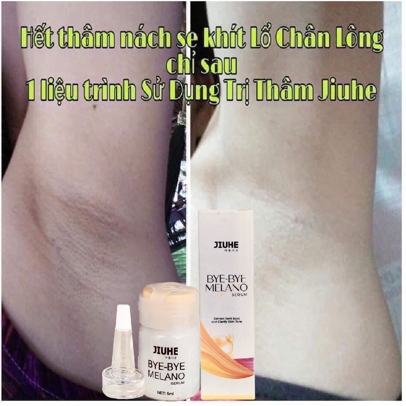 Serum tri thâm hàn quốc JIUHE Q-PEARL giảm thâm do mụn khửu tay chân, thâm sẹo, thâm nách hiệu quả