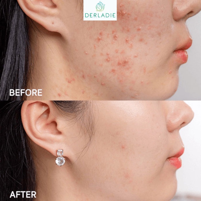 [Derladie] Serum Hỗ Trợ Giảm Mụn, Mờ Thâm Hàn Quốc