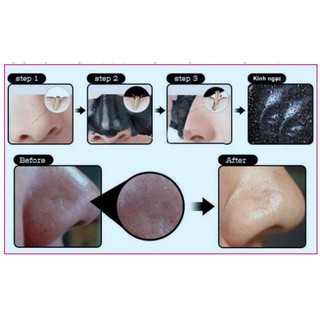 Gel Lột Mụn Đầu Đen 𝐌𝐢𝐬𝐭𝐢𝐧𝐞 𝐁𝐥𝐚𝐜𝐤𝐡𝐞𝐚𝐝 𝐁𝐥𝐚𝐜𝐤 𝐇𝐞𝐚𝐝 𝐂𝐚𝐫𝐛𝐨𝐧 𝐏𝐞𝐞𝐥 𝐎𝐟𝐟 𝐌𝐚𝐬𝐤