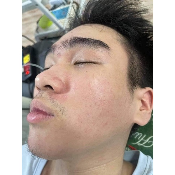 Thảo mộc thiên nhiên Hỗ Trợ Giảm Mụn | BigBuy360 - bigbuy360.vn