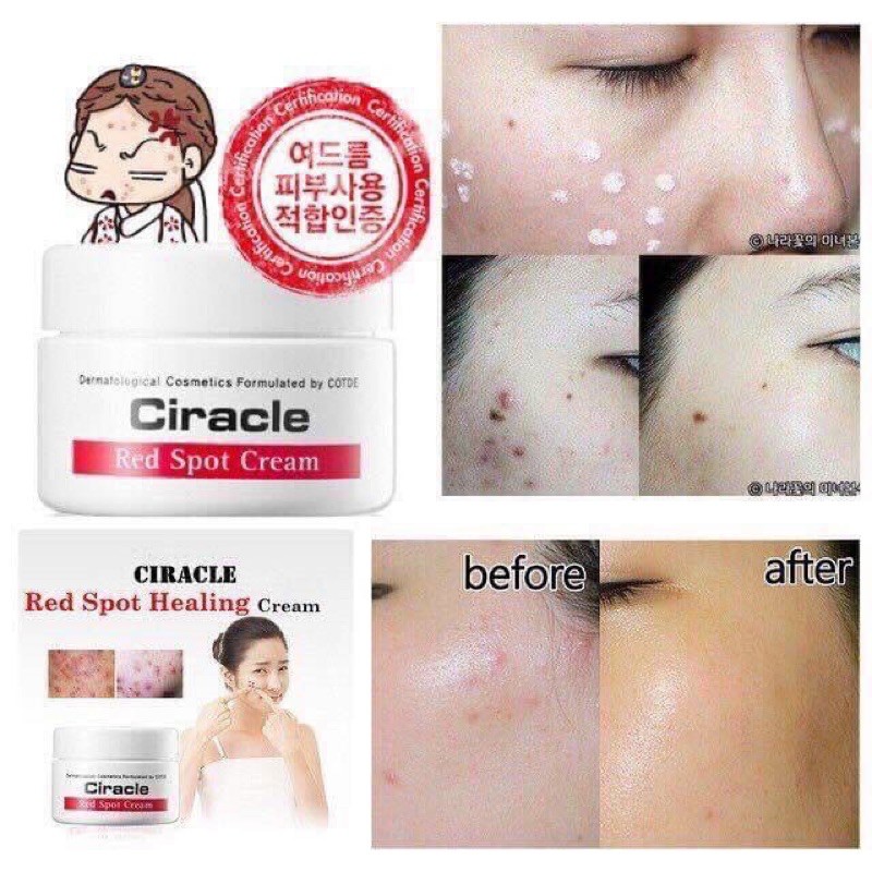 KEM NGĂN NGỪA MỤN VIÊM VÀ SẸO CIRACLE RED SOPT CREAM CHÍNH HÃNG