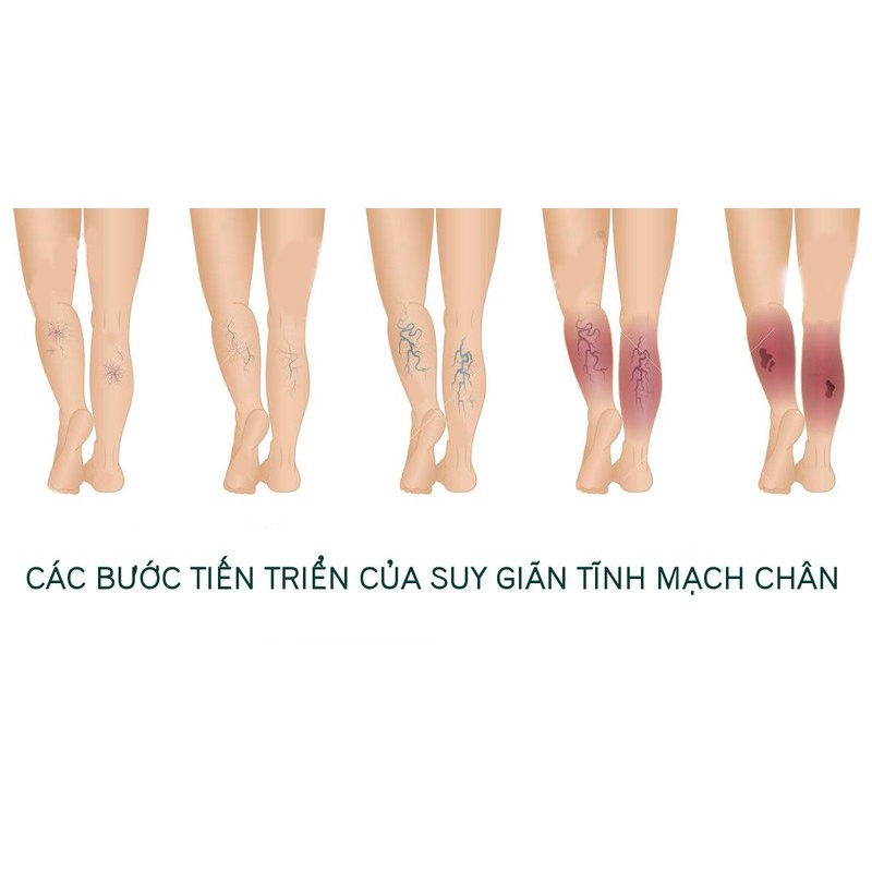 VIÊN UỐNG CHỐNG GIÃN TĨNH MẠCH NHẬT BẢN