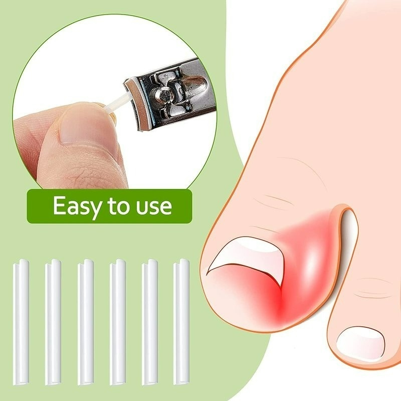 Hộp 1 Hộp Miếng Đệm Co Giãn Chỉnh Sửa Móng Chân Mọc Ngược Trong Suốt Dùng 1 Lần