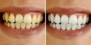 Bột than tre hoạt tính trắng răng
