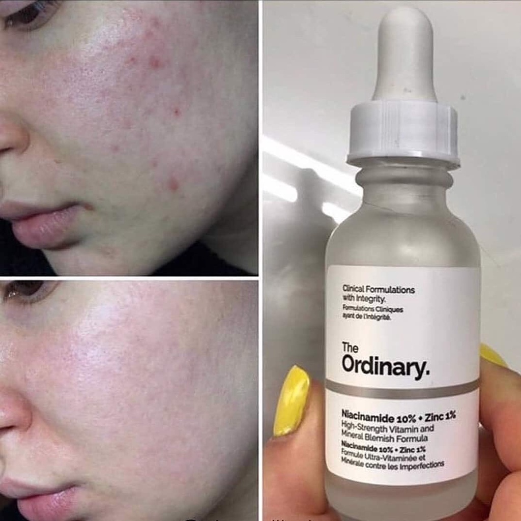 Serum Ngăn Ngừa Mụn, Se Khít Lỗ Chân Lông, Sáng Da The Ordinary Niacinamide 10% + Zinc 1% UK