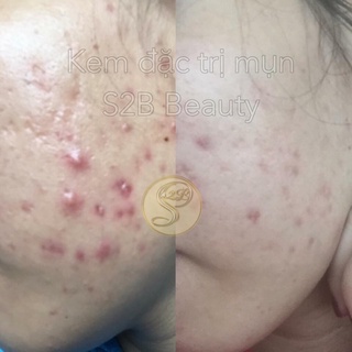 KEM NGỪA MỤN S2B BEAUTY