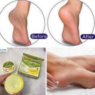 KEM TRỊ NỨT GÓT CHÂN CHUỐI