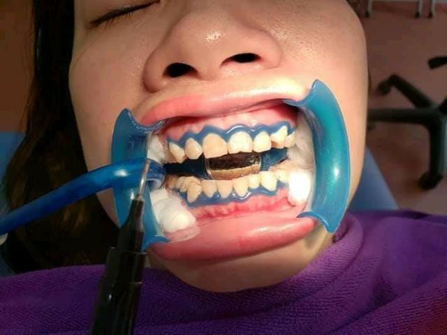 Tuýp che nướu tẩy trắng răng - Sử Dụng Cùng Máy Tẩy Trắng Răng
