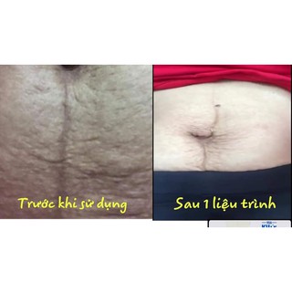 SIÊU DƯỠNG THÂM NÁCH-BỤNG-BIKINI