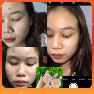 Miễn Phí Ship -  [CHÍNH HÃNG 100%] mini size 5g Cao mụn sâm đỏ MEEA ORGANIC
