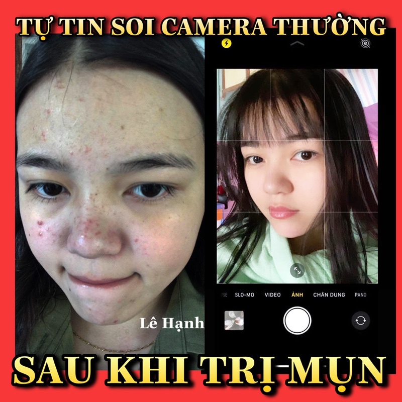 GEL CHẤM MỤN CENLIA ANTI ACNE 15ML | BigBuy360 - bigbuy360.vn