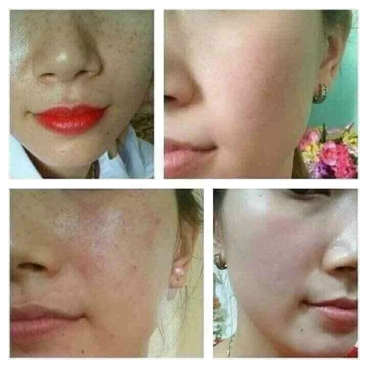 Kem giảm Nám Tàn Nhang Thái Lan Clobetamil G Cao Cấp