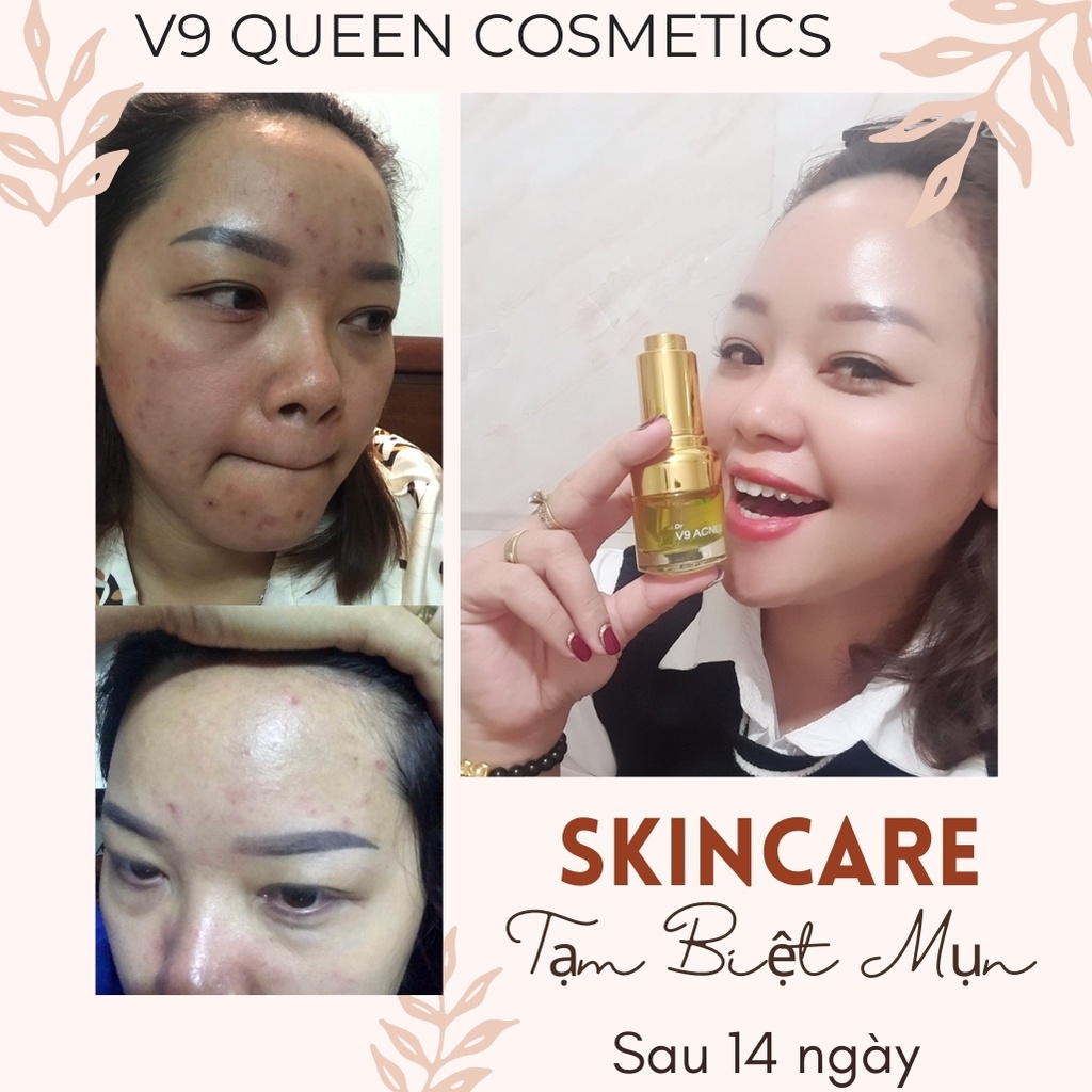Serum Ngăn Ngừa Mụn V9Queen, Chiết Xuất Rau Má Giúp Dưỡng Trắng Da, Làm Mờ Thâm Mụn - V9 Acnes 20ml