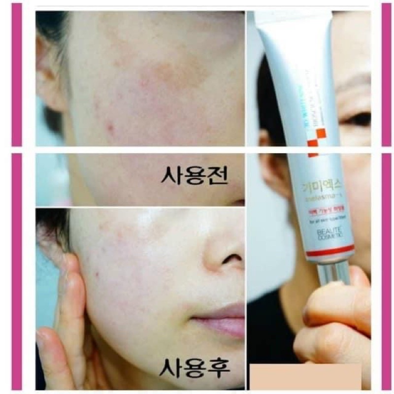 Kem mờ thâm, nám Melasma-x 3D White Clinic Cream Hàn Quốc