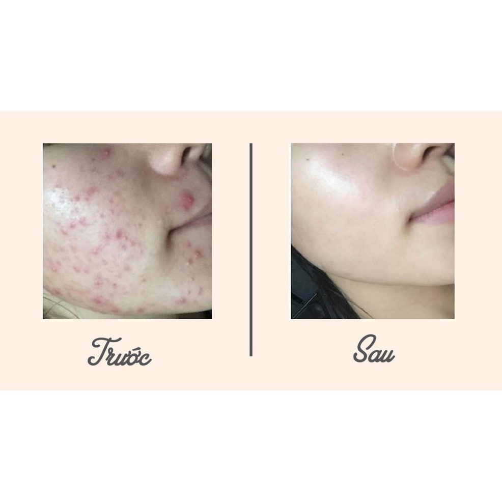 Kem ngăn ngừa mụn Mian 12gr_ Sản phẩm thiên nhiên | BigBuy360 - bigbuy360.vn