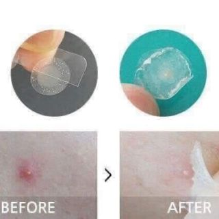 🐝🐝MIẾNG DÁN MỤN OLIVE YOUNG MẬT ONG 🐝🐝