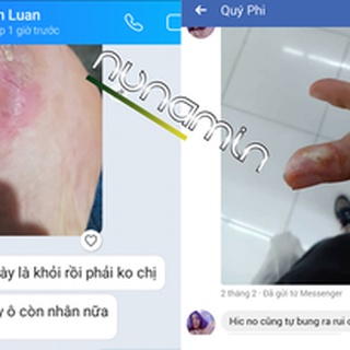 Mụn cóc , mụn thịt , mắt cá , chai chân Nunamin