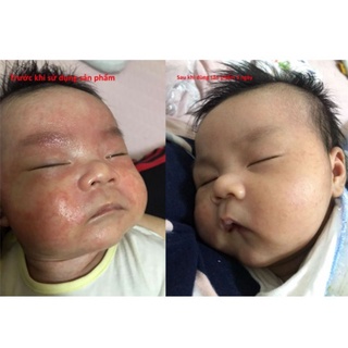Kem chàm sữa cho bé Kutieskin giảm ngứa nhanh, dịu mẩn đỏ, cải thiện da bong tróc nứt nẻ- Tuýp 30gr