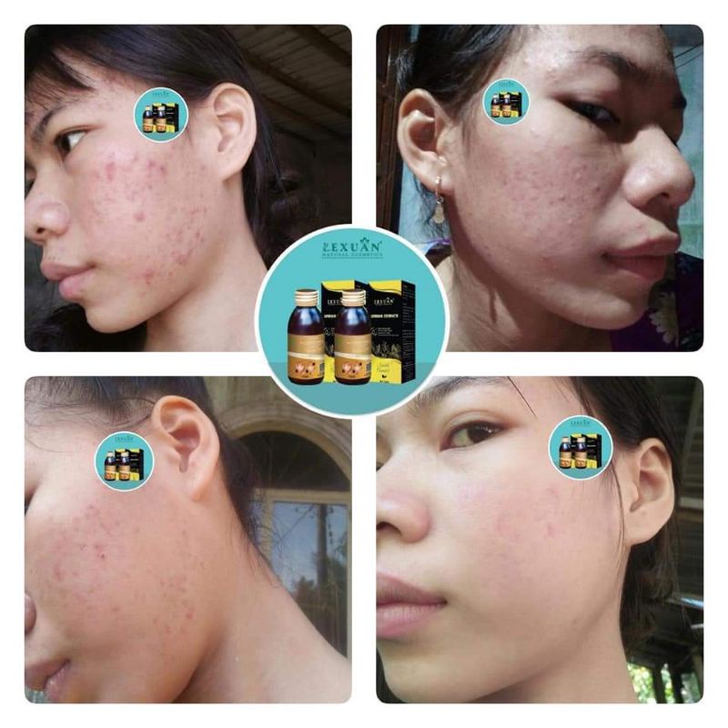 Thảo Dược Đông Y Lê Xuân🍒Trắng Da-Kiềm dầu-Mờ Thâm Nám | BigBuy360 - bigbuy360.vn