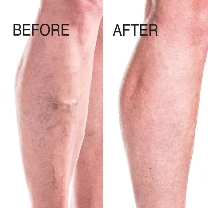 Kem hỗ trợ giãn tĩnh mạch ADVANCED CLINICALS Vein Care Varicose 237ml USA