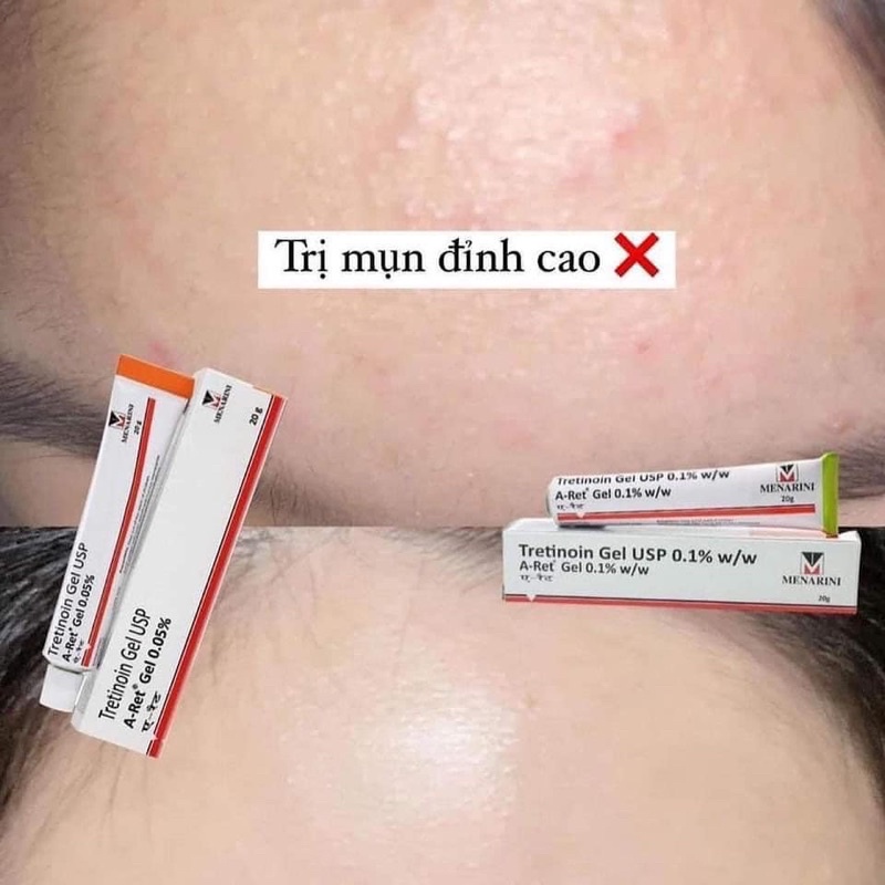 Tre Ấn Độ - Momo Cosmetic