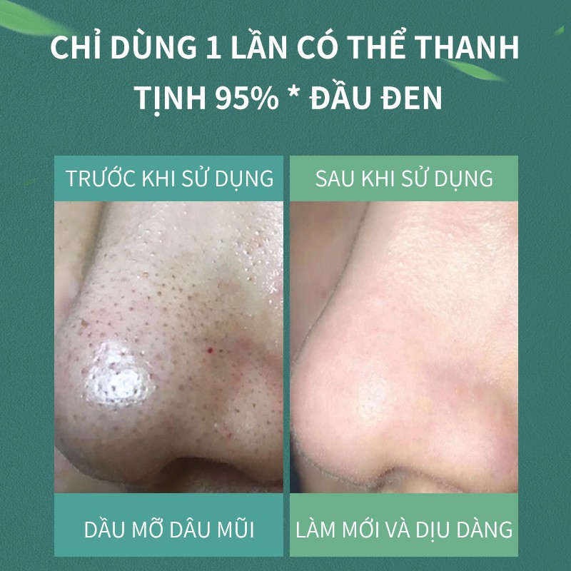Set 50 miếng dán SOONPURE lột mụn đầu đen trên mũi 11g | BigBuy360 - bigbuy360.vn