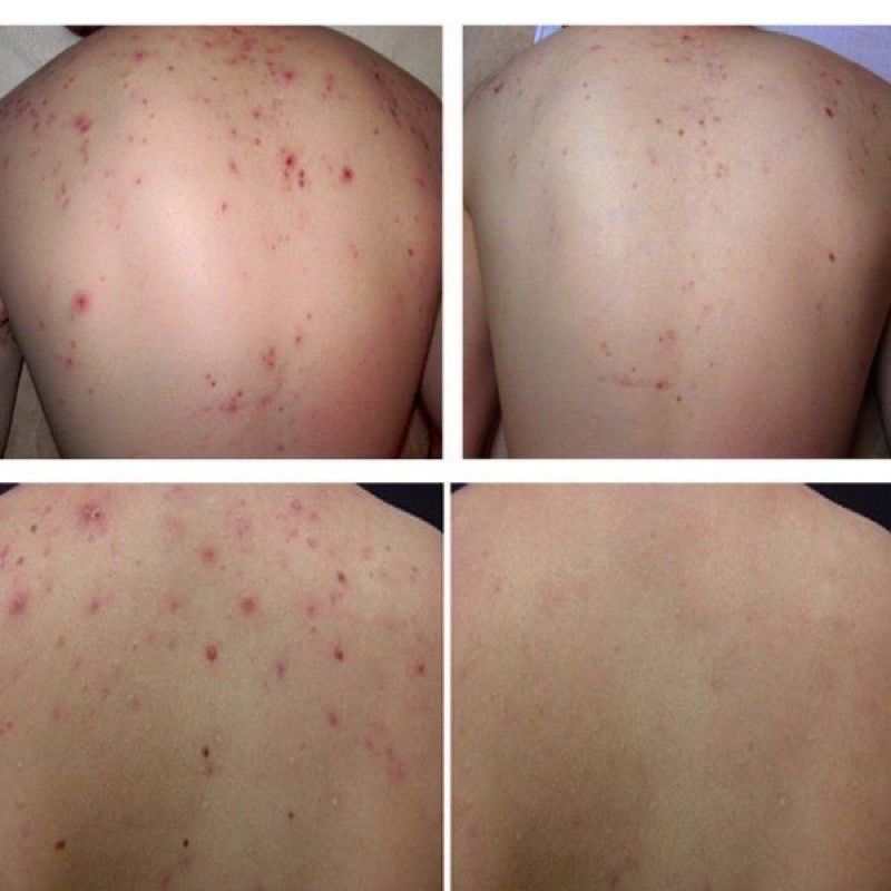 Xà phòng giảm mụn lưng Neva- Nội địa Nga | BigBuy360 - bigbuy360.vn