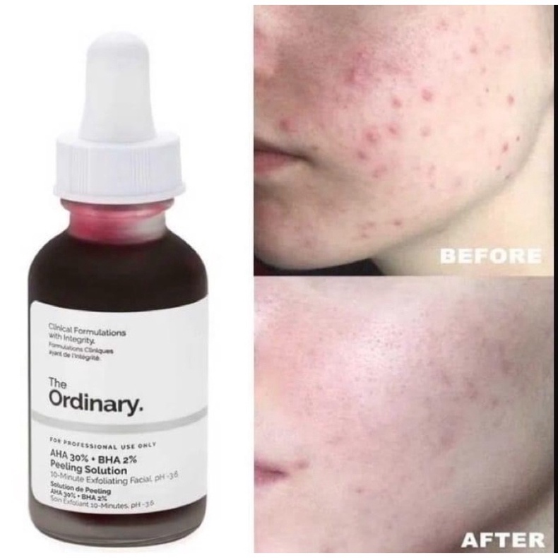 [USA] 🦋Tẩy Tế Bào Chết Mặt The Ordinary AHA 30% + BHA 2% Peeling Solution 30ml