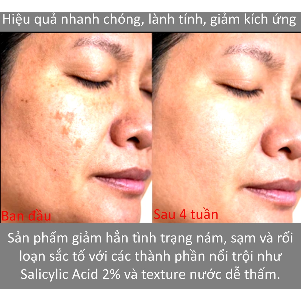 Toner 2% BHA Tẩy da chết mặt bớt mụn da dầu trắng sáng thông thoáng lỗ chân lông SIMPLICITY