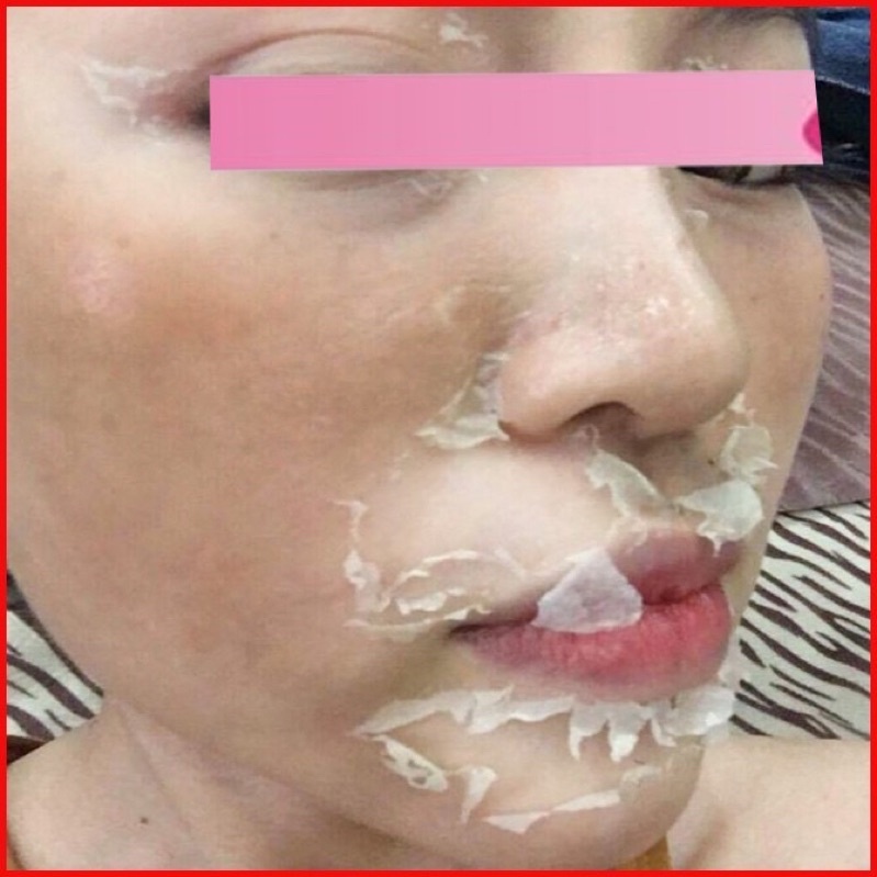 Tái Tạo Lột Thay Da Trắng Hết Nám Bezy