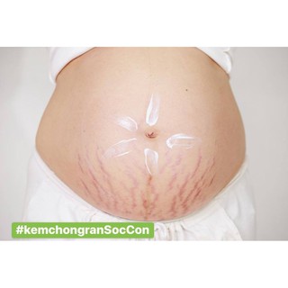 KEM CHỐNG RẠN CHỐNG, LÀM MỜ VẾT SẸO, RẠN DA [AN TOÀN MẸ BẦU, MẸ BỈM]