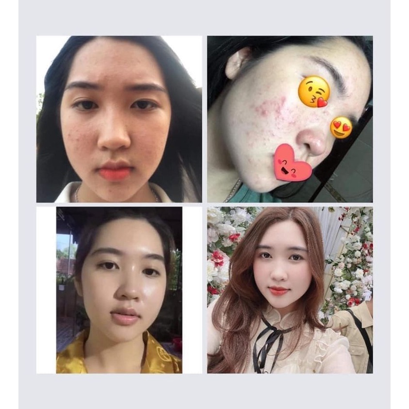 Serum giảm mụn mờ thâm, Dr skinbeauty, Ngừa mụn, Mờ thâm 5ml