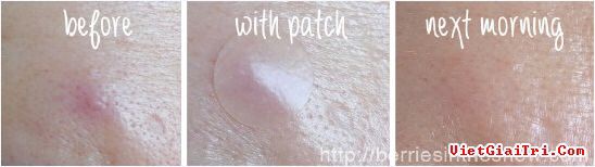 Miếng dán cho mụn Acne Pimple Master Patch