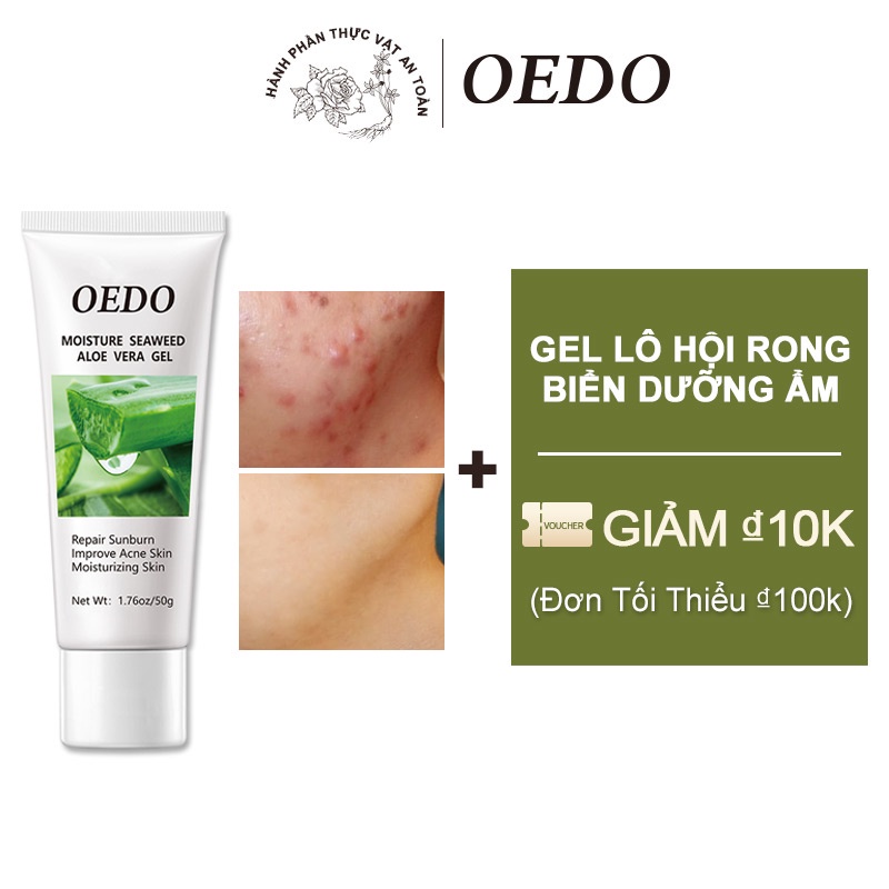 Gel Lô Hội Aloe Vera Soothing OEDO Dưỡng Ẩm Trắng Da Hiệu Quả Thúc đẩy trình chữa lành các vết sẹo mới Kiềm Dầu Nâng Tone Trẻ Hóa 50g