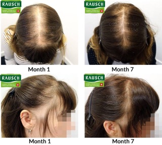 Tinh Dầu Trị Hói Rausch Từ Thuỵ Sĩ