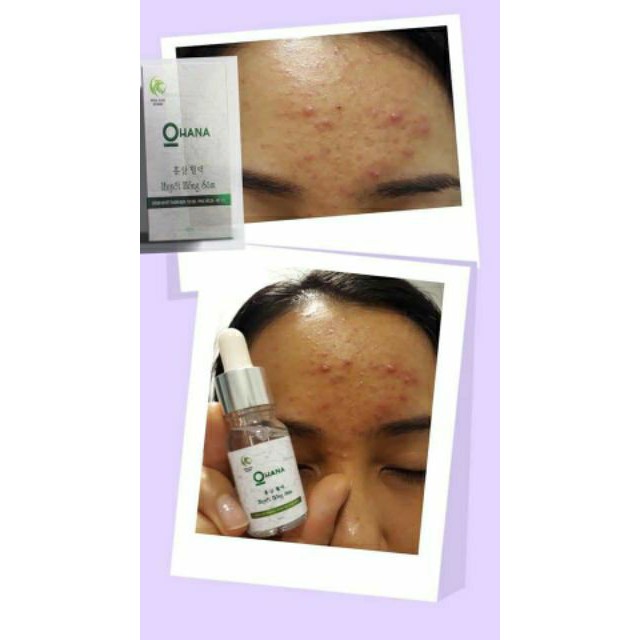 HUYẾT HỒNG SÂM - VUA TRỊ MỤN - TÁI TẠO | BigBuy360 - bigbuy360.vn