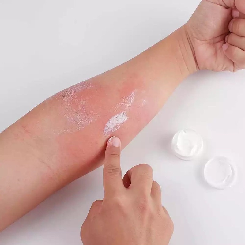 - Gel Fenistil bôi muỗi đốt, côn trùng, cháy nắng - 30g