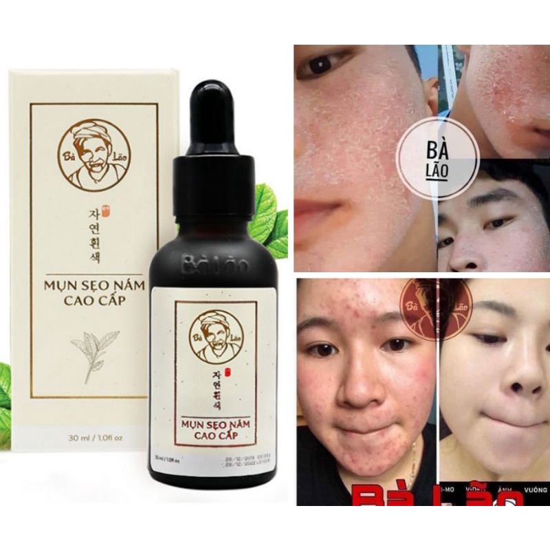 Serum Bà Lão Mụn Sẹo Nám Cao Cấp Giúp Tái Tạo Làn Da Mới Giảm Mụn Tuyệt Đối