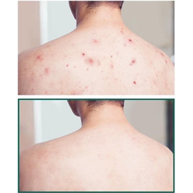 SỮA TẮM SOME BY MI ACNE CLEAR BODY | BigBuy360 - bigbuy360.vn