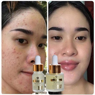 Tinh Chất TRI MUN tận gốc Doctor Care -Tinh Chất TRI sạch nhân mụn doctor care