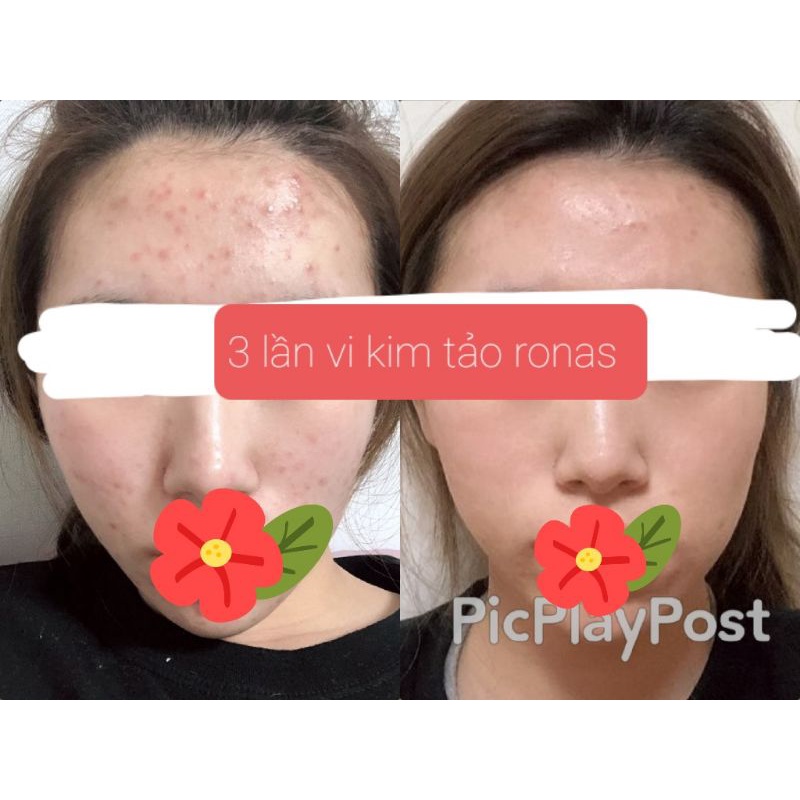 Tinh chất phục hồi te bao goc laksmira