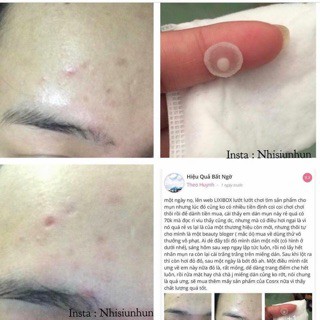 Miếng dán hút mụn Hàn Quốc